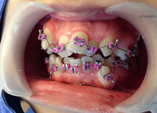 Los Mejores Tweets ™ on Twitter: "Una sonrisa con brackets ENAMORA ... Los Mejores Tweets ™ on Twitter: "Una sonrisa con brackets ENAMORA ...
