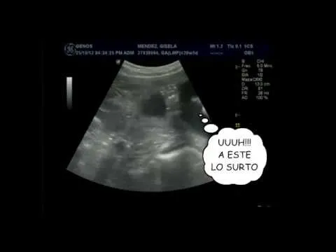 Mellizos se pelean en la panza - YouTube