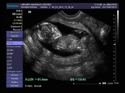 3 meses de embarazo - YouTube