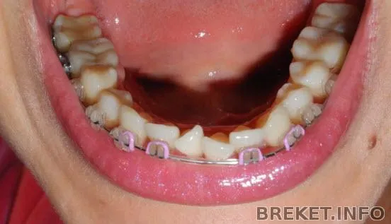 2 месяца 22 дня + лавандовые лигатурки=) | Дневник пользователя ...