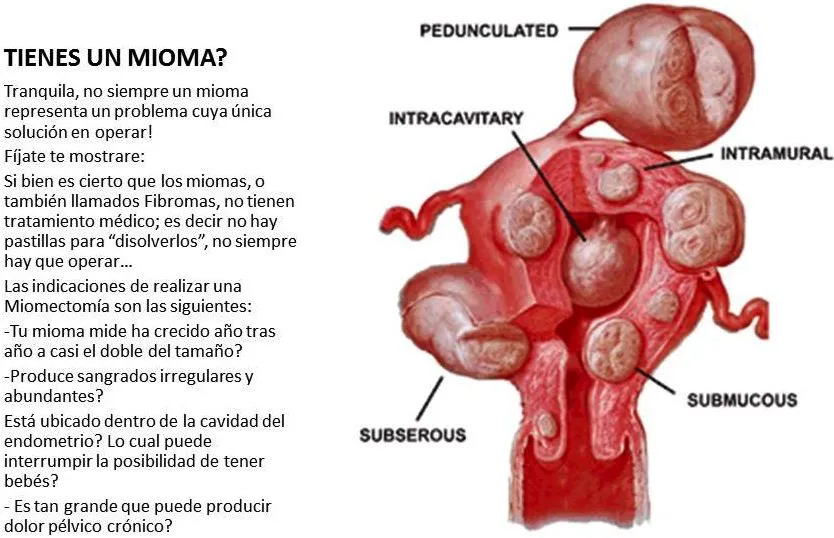 mioma-benigno.jpg