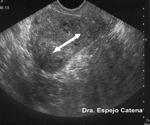 El mioma uterino (fibroma o leiomioma) | MEDICINA DE LA ... El mioma uterino (fibroma o leiomioma) | MEDICINA DE LA ...