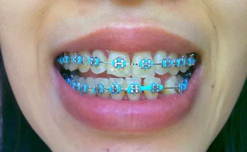 My Life with Braces