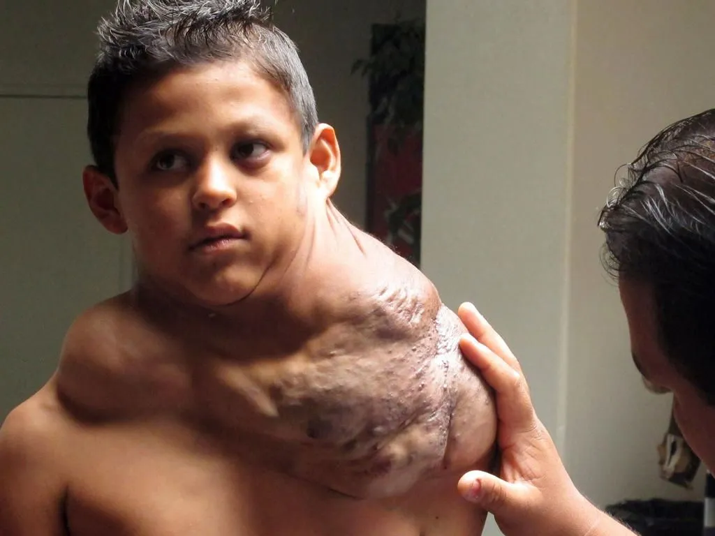 Niño mexicano se recupera tras operación en la que le extirparon parte de este tumor Niño mexicano se recupera tras operación en la que le extirparon parte de este tumor