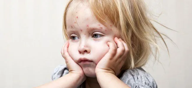 Niños y bebés con rubéola