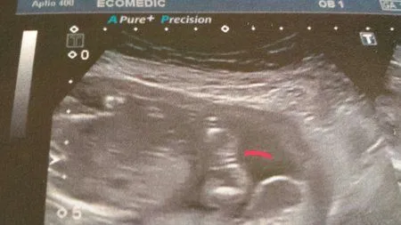 que opinais? me dijeron q es niña - Bebés De Agosto 2014 - BabyCenter