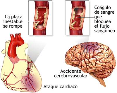 organos afectados por el hta « caso clinico del hta organos afectados por el hta « caso clinico del hta