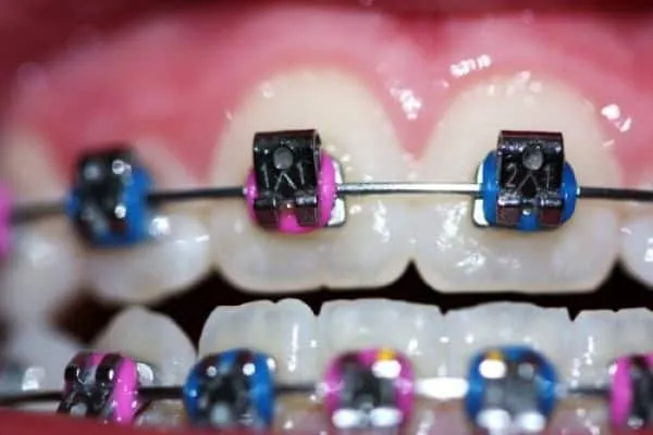 Brackets de colores