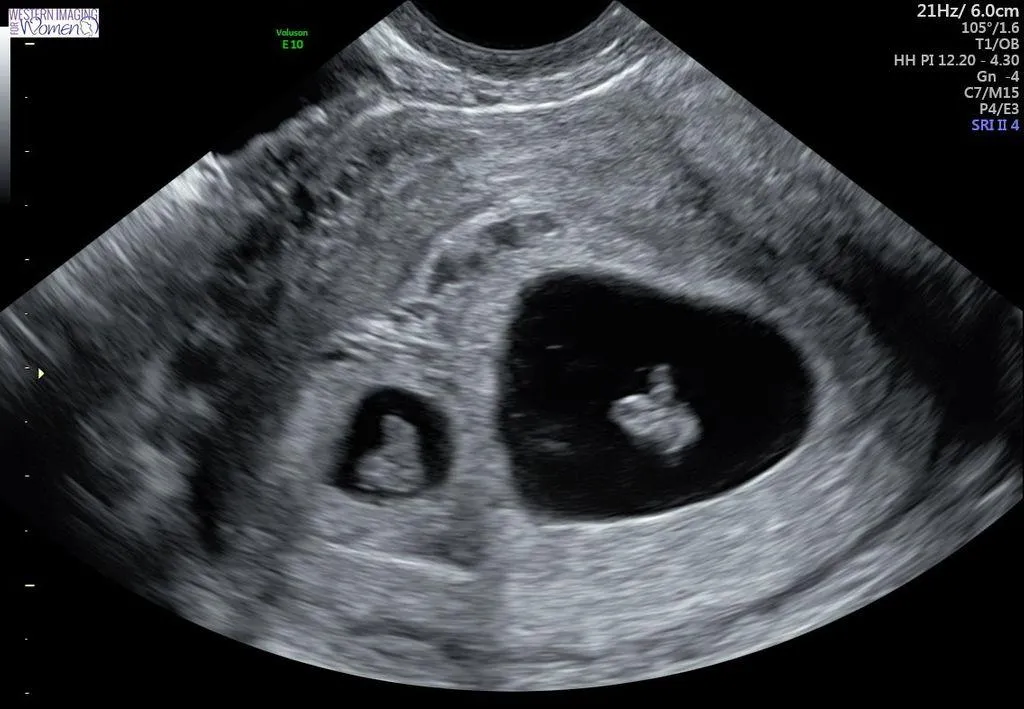 Qué pasa si hay dos sacos gestacionales de diferente tamaño en el embarazo Qué pasa si hay dos sacos gestacionales de diferente tamaño en el embarazo