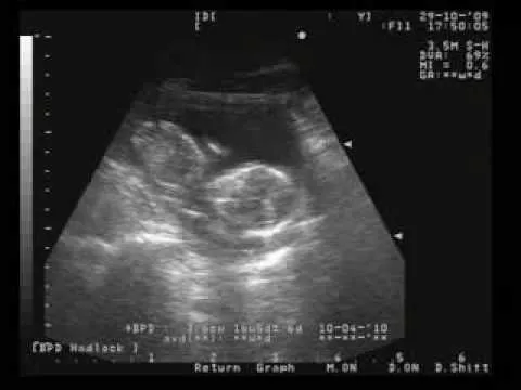 Patitow!!! Ultrasonido Bebesukis 4 meses - YouTube