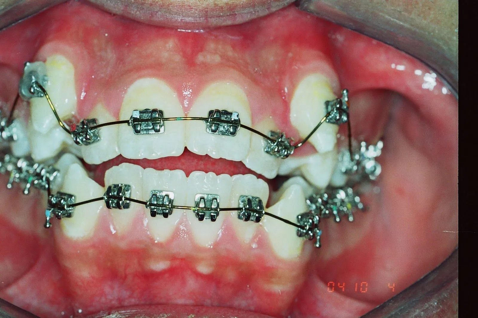 ... Pediatrica: Caso Clínico de Ortodoncia con Brackets Metálico ... Pediatrica: Caso Clínico de Ortodoncia con Brackets Metálico