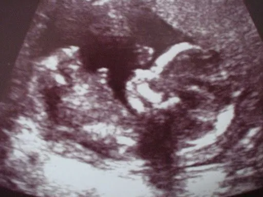 Ecografía 16 semanas, la niña. Ecografía 16 semanas, la niña.