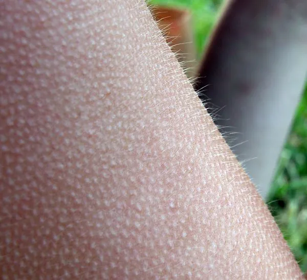 Por qué se nos pone la piel de gallina? - Taringa! Por qué se nos pone la piel de gallina? - Taringa!