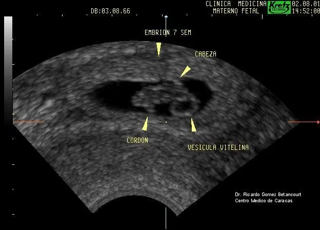  ... pongo la imagen de la pagina maternofetal net de un feto de 7 semanas