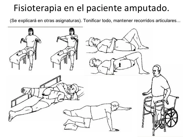 Prótesis y rehabilitación de amputados