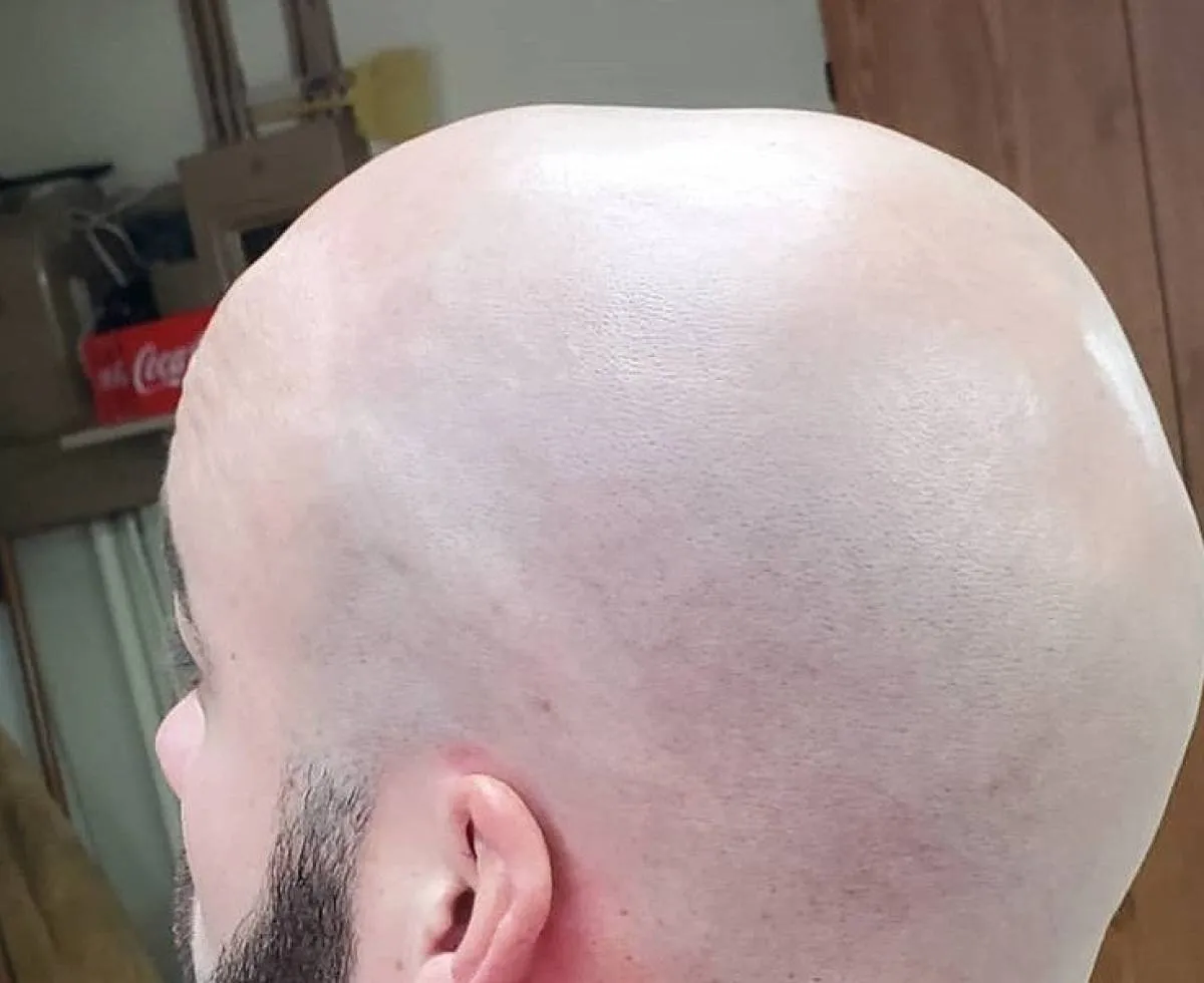 Fui a un psicólogo de calvos para que me enseñara a amar mi alopecia