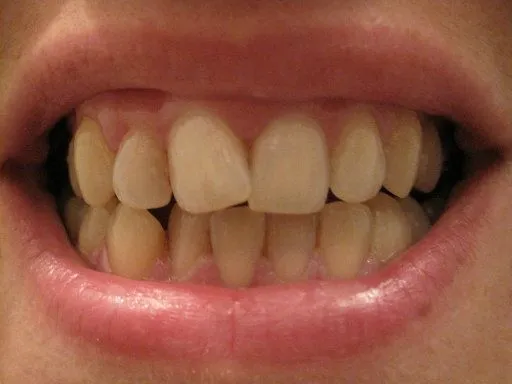 me quiero poner aparato en los dientes (pág. 87) | Cuidar de tu ... me quiero poner aparato en los dientes (pág. 87) | Cuidar de tu ...