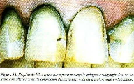 RCOE - Técnica y sistemática clínica de la preparación y ...