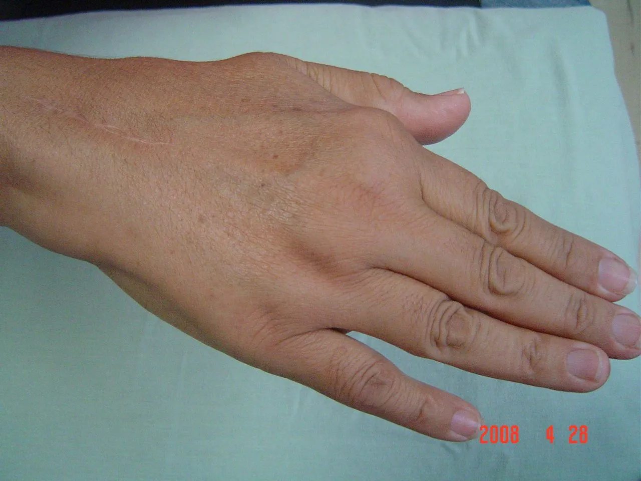 Reparación de tendones extensores en artritis reumatoide | OSSA ... Reparación de tendones extensores en artritis reumatoide | OSSA ...