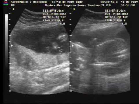 Resonancia Magnetica Parte 1, a los 5 meses 21 semanas de ... Resonancia Magnetica Parte 1, a los 5 meses 21 semanas de ...