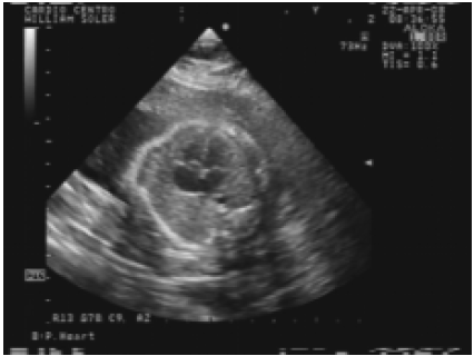 Revista argentina de cardiología - Ecocardiografía fetal