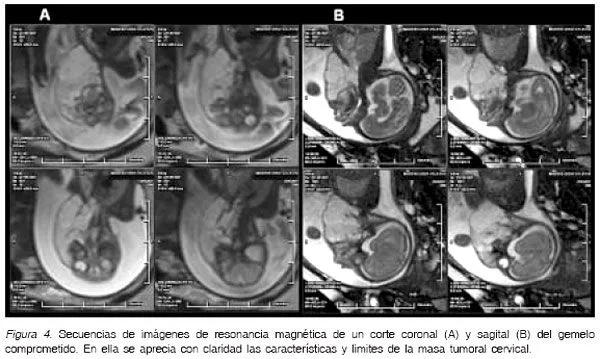 Revista chilena de obstetricia y ginecología - LINFANGIOMA ...