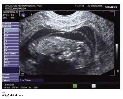 Revista Colombiana de Obstetricia y Ginecología - Increased foetal ... Revista Colombiana de Obstetricia y Ginecología - Increased foetal ...