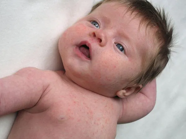 RONCHITAS EN LA PIEL!!! ES NORMAL?? | pediatria on line RONCHITAS EN LA PIEL!!! ES NORMAL?? | pediatria on line