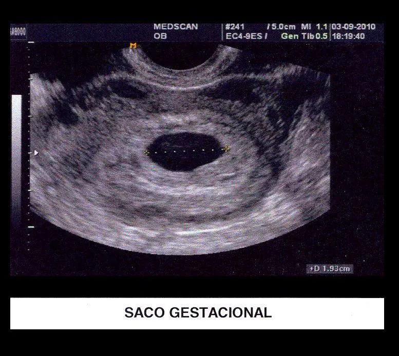 Saco Gestacional 0 Pictures