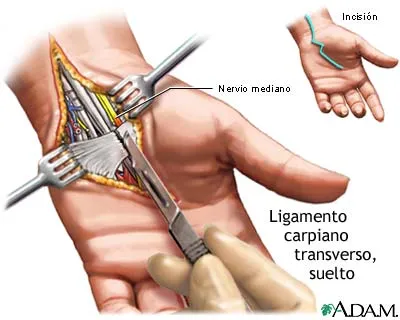SALUD OCUPACIONAL: SÍNDROME DEL TÚNEL CARPIANO SALUD OCUPACIONAL: SÍNDROME DEL TÚNEL CARPIANO
