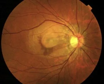 ScienceDirect.com - Archivos de la Sociedad Española de ... ScienceDirect.com - Archivos de la Sociedad Española de ...