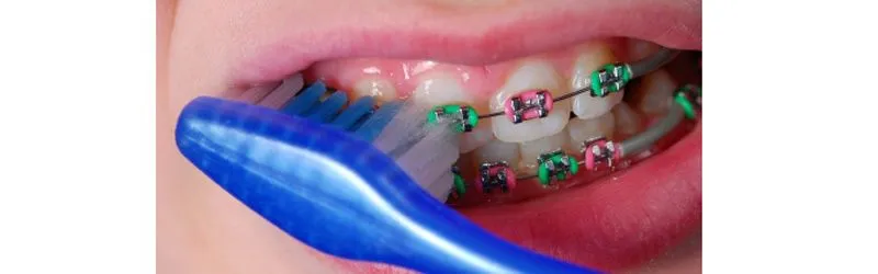 SEJNAUI ORTODONCIA » Colores de brackets, un look diferente para ...