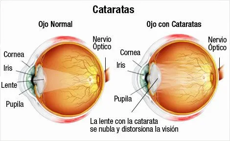 El sentido de la vista; Enfermedades, defectos y problemas ... El sentido de la vista; Enfermedades, defectos y problemas ...