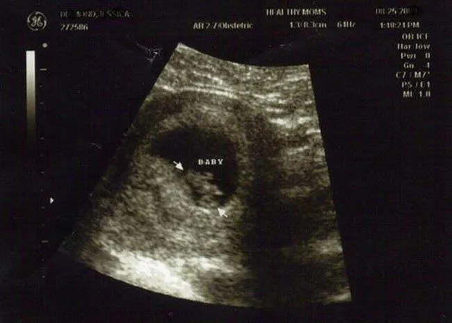 Embarazo de 2 meses - Bebés y más - Página 1