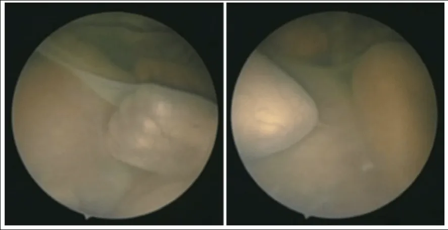 El Síndrome de Transfusión Feto Fetal (II): Pronóstico ...