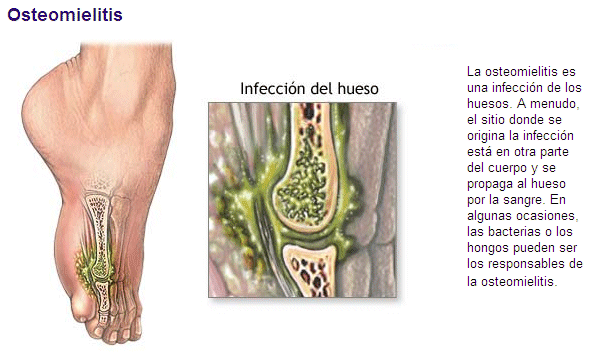 Sistema Locomotor: EMFERMEDADES DEL SISTEMA LOCOMOTOR