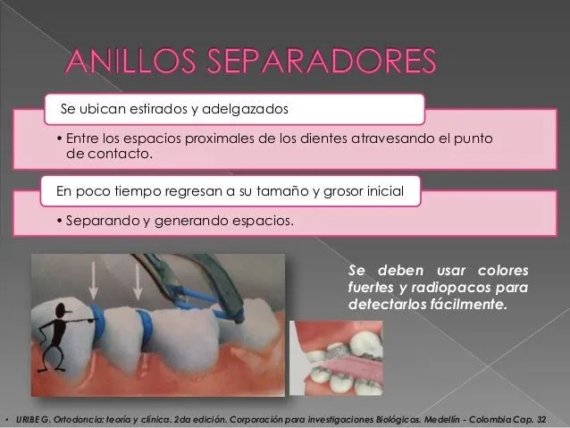 Sistemas de fuerzas estáticamente determinados, Cantilivers, Cinchado…