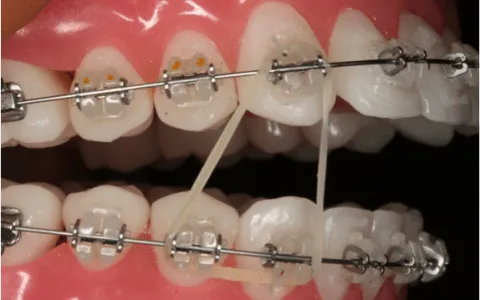 Sobrevivir a los brackets: ¿Elásticos intermaxilares?