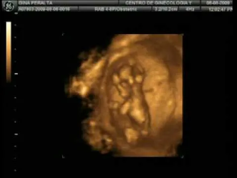 SONOGRAFIA 3D DE MI BEBE CON 3 MESES EN EL VIENTRE - YouTube