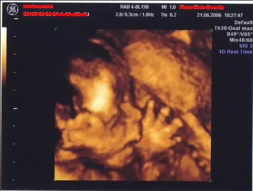 Sonografias de 4 meses - Imagui