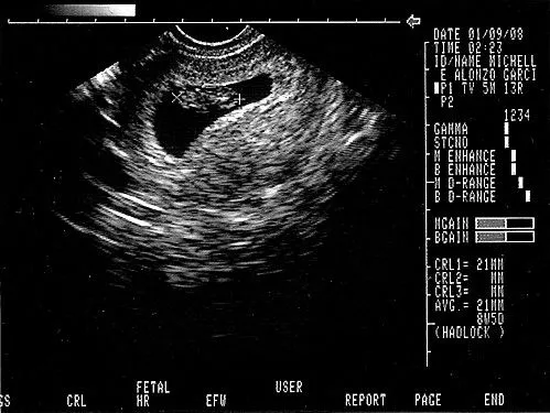 Sonogramas de bebés - Imagui