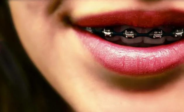 Stefania Notararigo: Brackets: ¿Lujo innecesario?