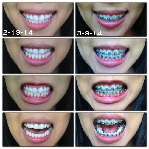 surviving braces | Tumblr