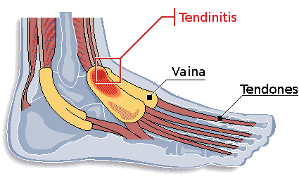 Tendinitis: menos marcha y más agua.