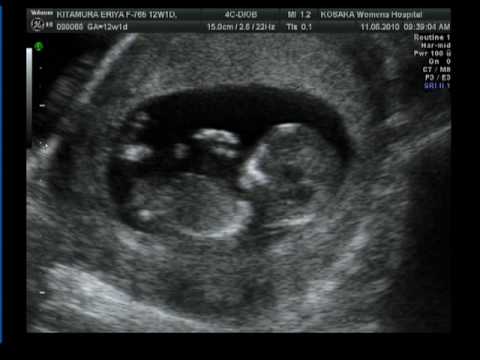 tercer mes de gestacion de mi bebe! - YouTube tercer mes de gestacion de mi bebe! - YouTube