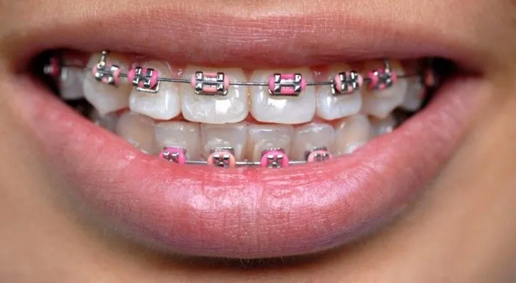 Thoughts? Fashionable Faux Braces? | Peacock Under Pressure Thoughts? Fashionable Faux Braces? | Peacock Under Pressure