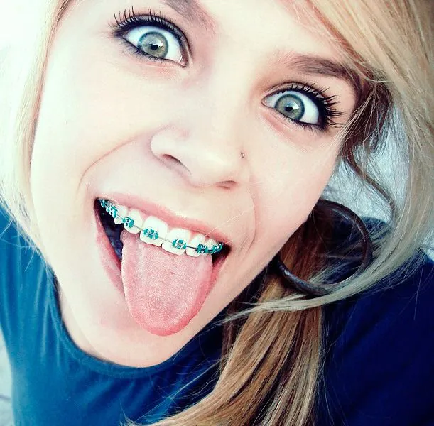 TO WEAR BRACES IS COOL