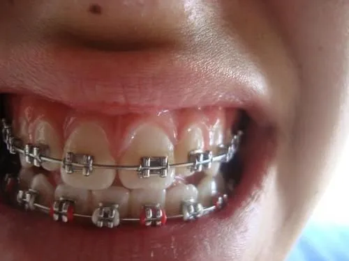 TO WEAR BRACES IS COOL
