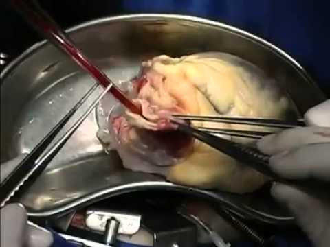 Transplante de corazón real - YouTube