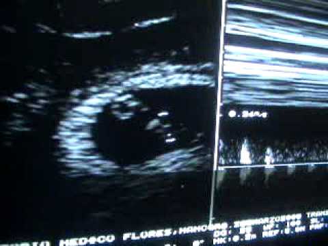 Transvaginal Ultrasound Pregnancy 6.4 weeks- Ultrasonido ... Transvaginal Ultrasound Pregnancy 6.4 weeks- Ultrasonido ...